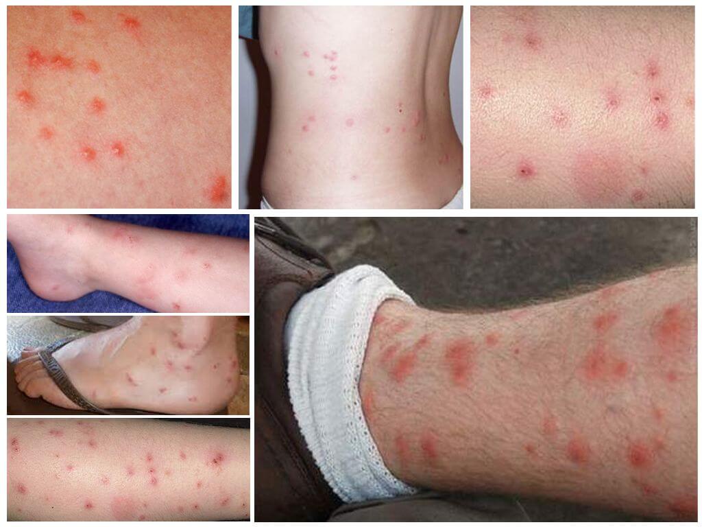 Kung paano tumingin ang mga kagat ng flea sa larawan ng balat ng tao