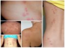 bedbugs bider