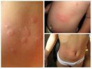 Allergia al morso delle pulci