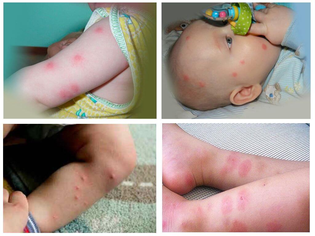 Ano ang gagawin kung ang isang bata ay nakagat ng mga pulgas, larawan ng kagat