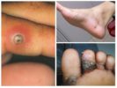 Sand Flea Bites-1