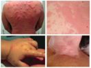 Allergi mod bedbugs