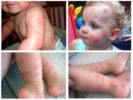 Allergia alle cimici dei bambini