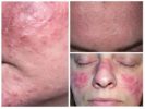 Subcutaneous Lice-1