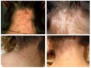 Pediculosis
