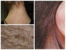 Mga uri ng Pediculosis