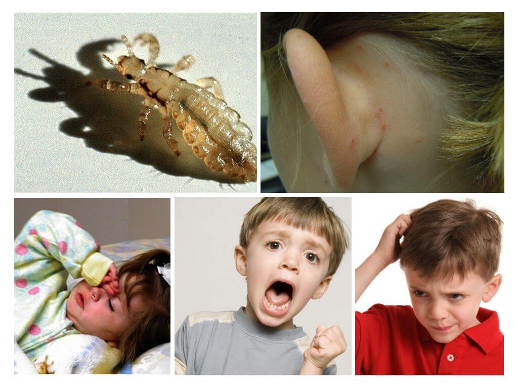 Ano ang mapanganib na pediculosis