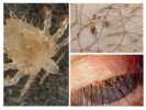 Fthyriasis