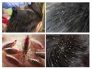 Pagkakaiba sa pediculosis