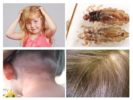 Pediculosis ในเด็ก