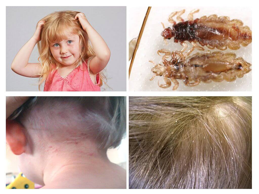 Pediculosis sa kindergarten