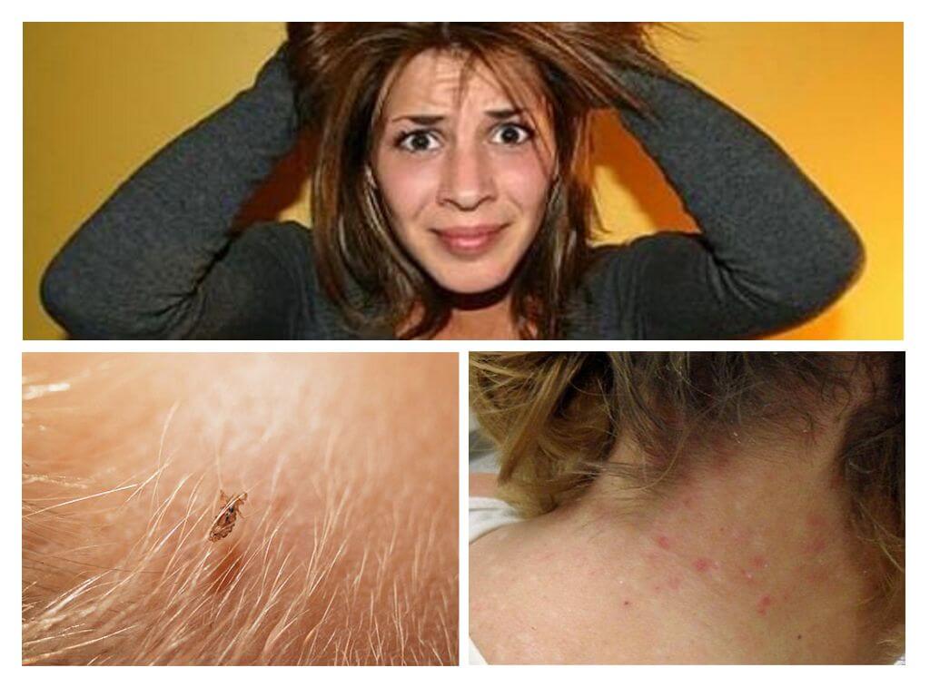 Pag-iwas sa mga kuto at scabies