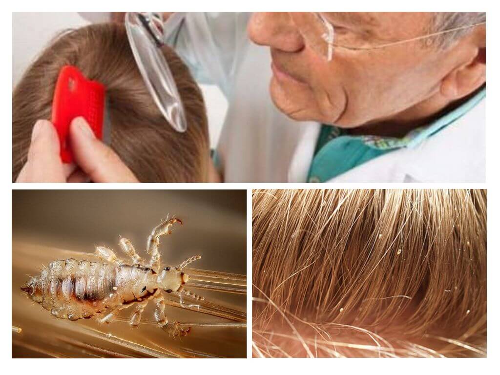 Pag-iwas sa Pediculosis sa Paaralan