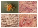Sintomas ng Pubic Lice