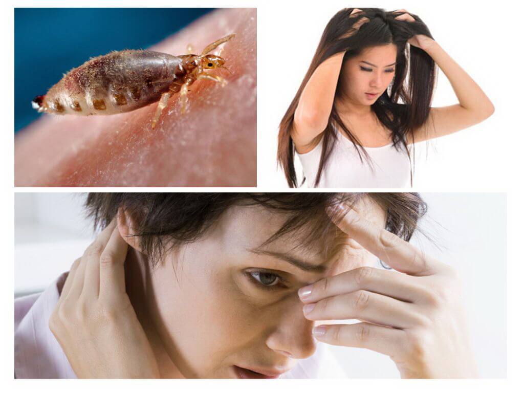 Maaari bang lumitaw ang mga kuto?