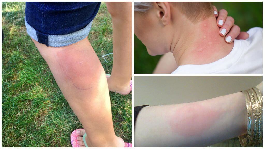 Behandling af allergier mod myggen hos en voksen og et barn
