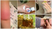 Mga recipe ng katutubong para sa kagat ng insekto