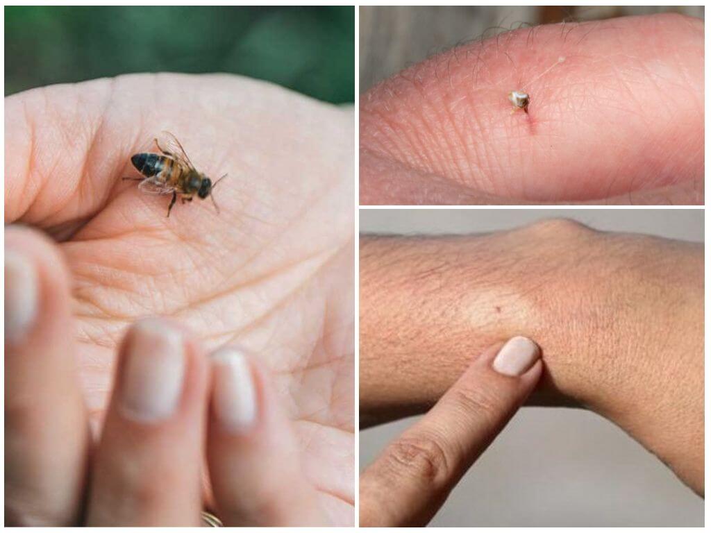Kuka kuolee mehiläisen tai ampiaisen puremana