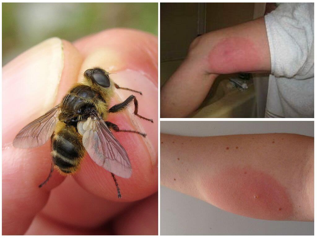 Mitä tehdä, jos perhonen purema on turvonnut ja punoittunut
