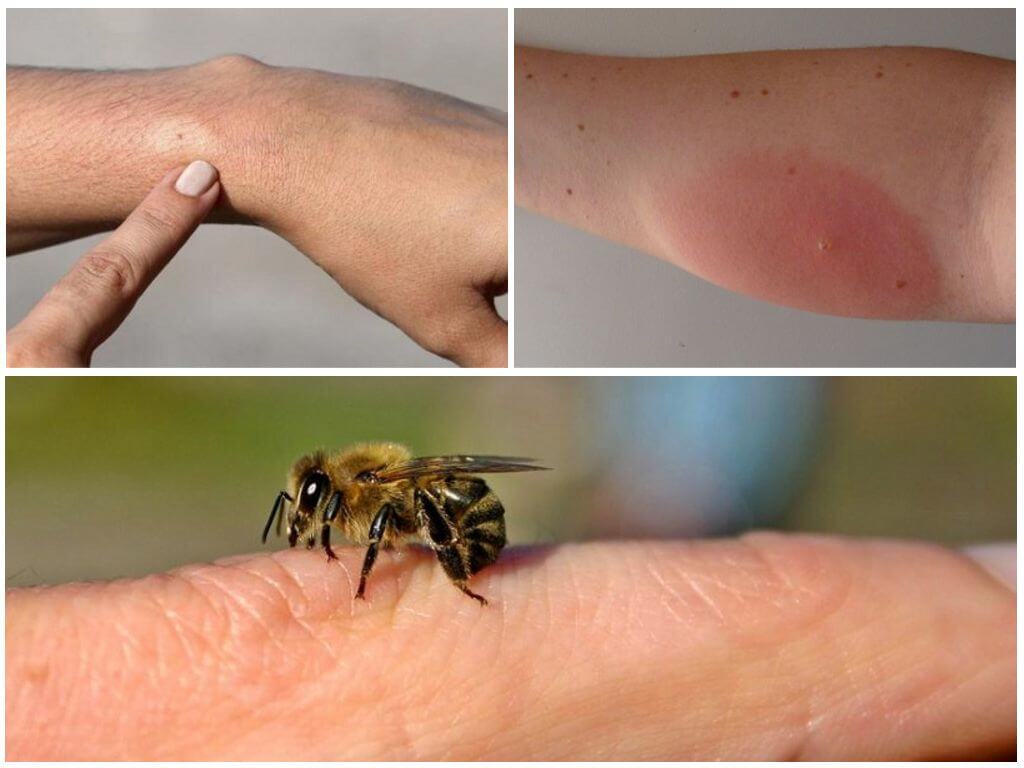 Allergiset reaktiot mehiläisen pistoon, mitä tehdä