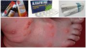 Bite allergy
