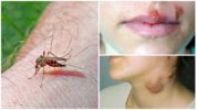 Malaria at tularemia mula sa mga lamok