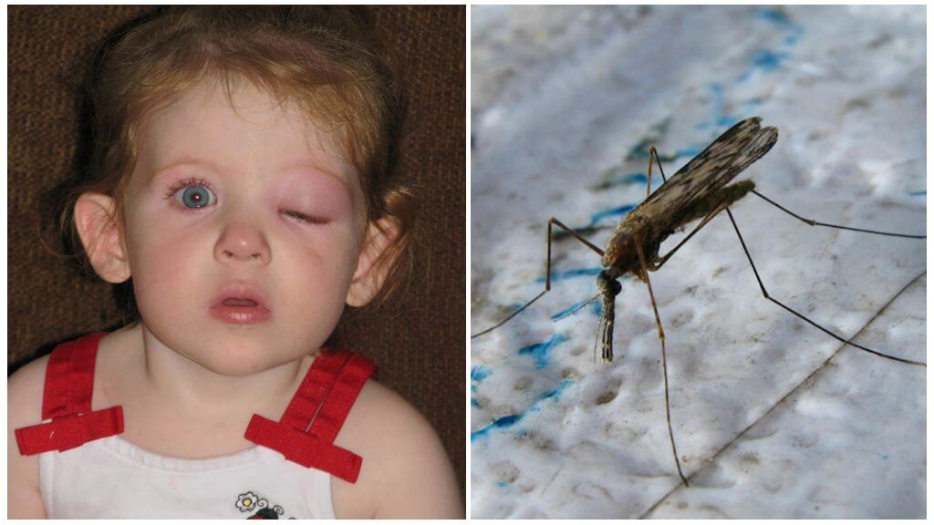 Cosa fare se un bambino ha un occhio gonfio dopo una puntura di zanzara