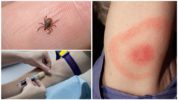 การตรวจเลือดเพื่อหา borreliosis หลังจากกัดเห็บ