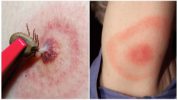 Ang sakit na Lyme o borreliosis na nadadala ng tik
