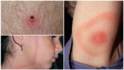 สัญญาณแรกของการ borreliosis