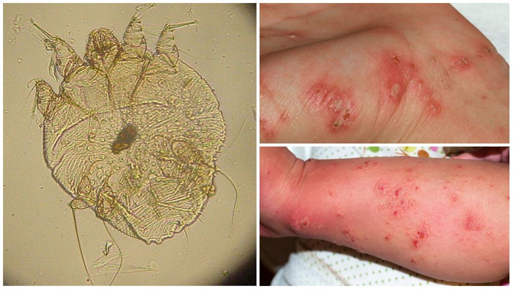 Human scabies mite