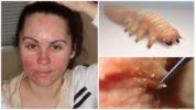 Demodecosis บนใบหน้า