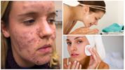 การรักษา demodicosis บนใบหน้าของบุคคล