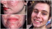 Demodecosis บนใบหน้าของบุคคล