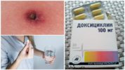 Doxiciclina després d'una picada de pessigolles