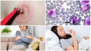 Monocytic ehrlichiosis sa mga tao
