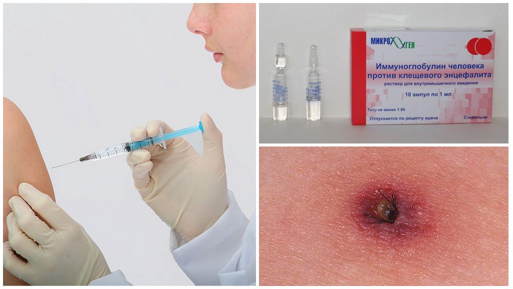 Tick-båret encephalitis immunoglobulin
