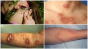May sakit na borreliosis