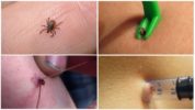 Mètodes per extreure una paparra a casa