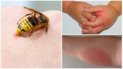 Allerginen reaktio ampiaispistokseen