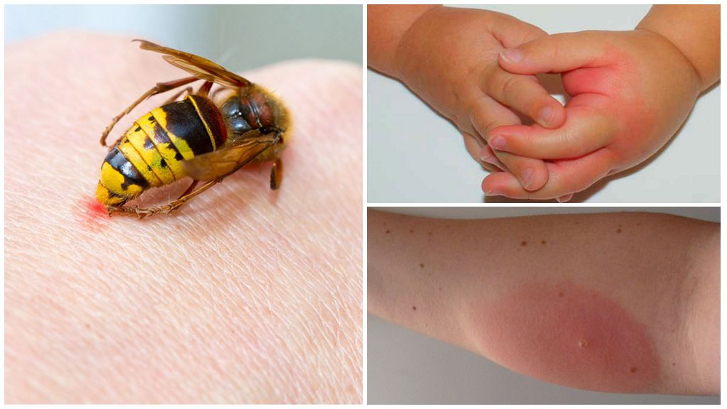 Allerginen reaktio ampiaispistokseen