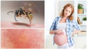 Wasp sting sa panahon ng pagbubuntis