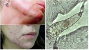 Demodecosis