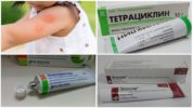 Unguenti per il trattamento di una puntura d'insetto