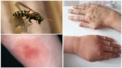 Wasp sting