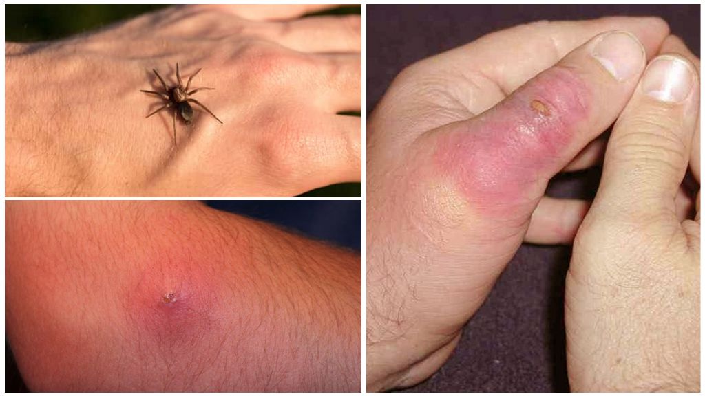 Beskrivelse og foto af bid af forskellige typer insekter hos børn og voksne