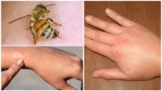 Bee sting