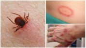 Borreliosi en adults