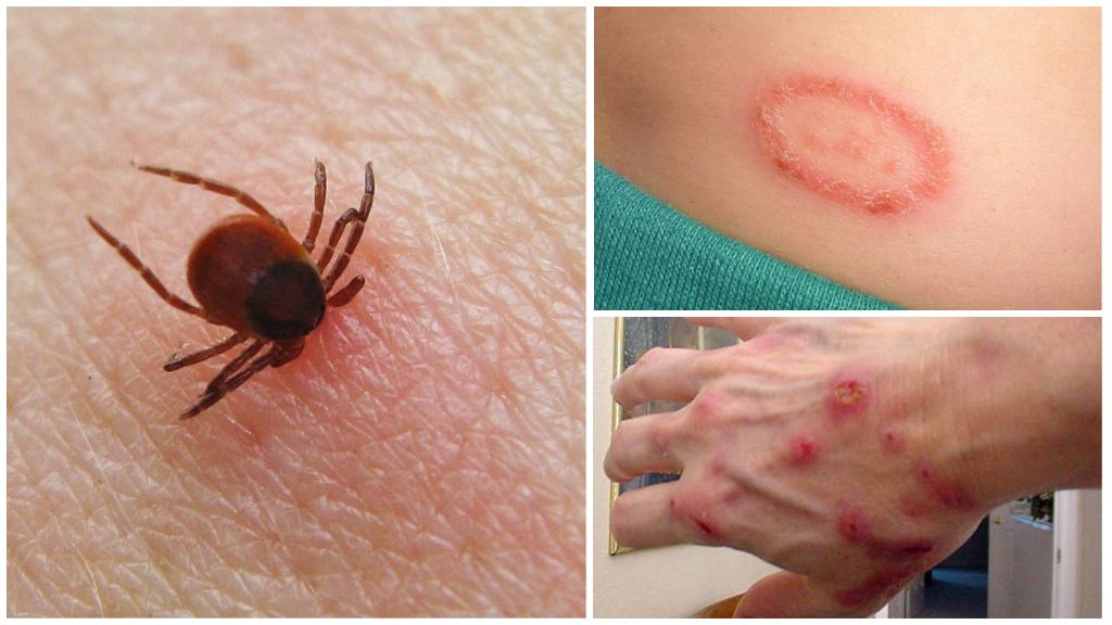 Antibiotica voor borreliose bij volwassenen