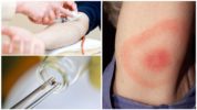 Laboratoriumdiagnose van borreliose